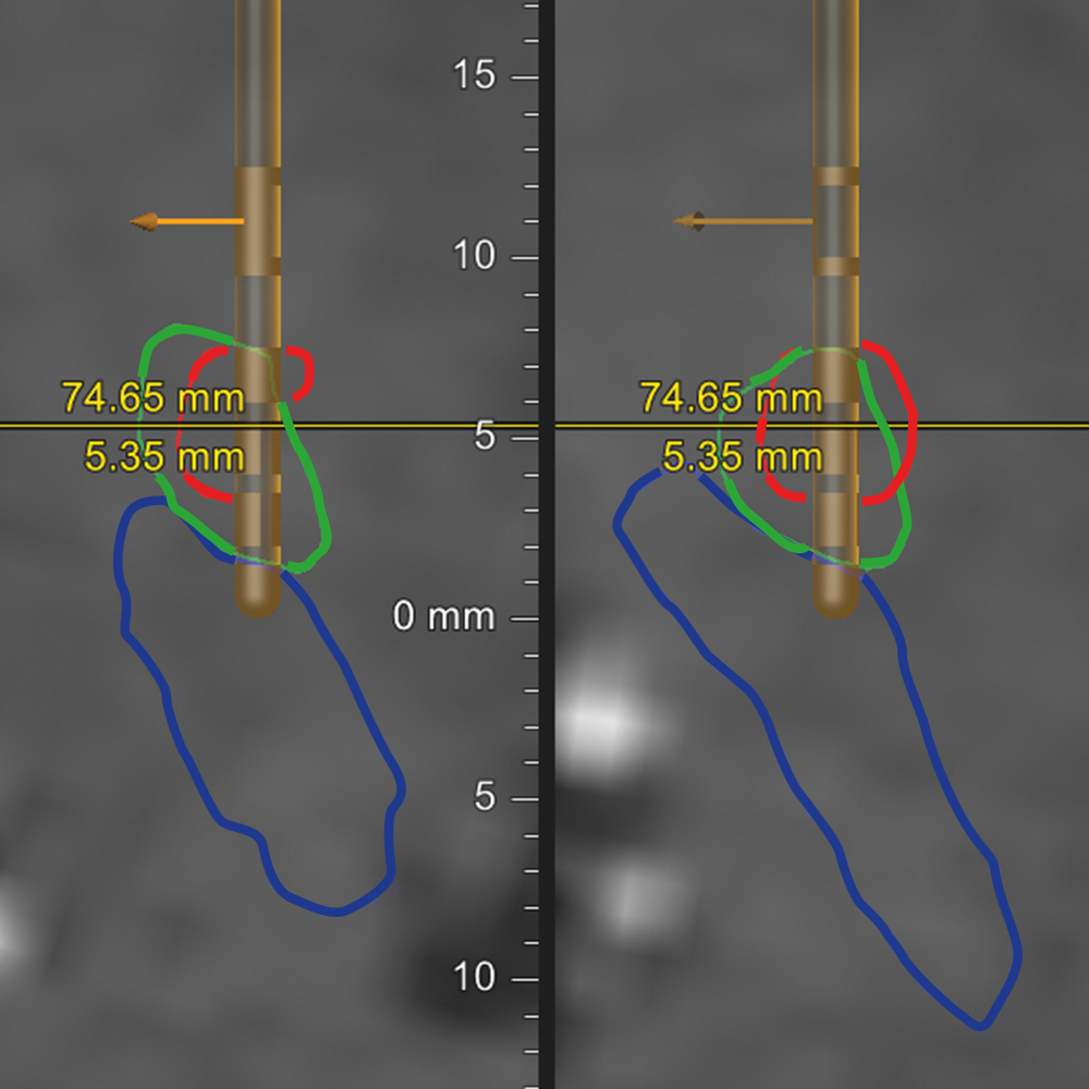 Animation des XT Screen beim Verfahren der Tiefen Hirnstimulation (THS) in zwei Ansichten nebeneinander